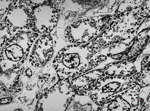 M, | newborn heart … mitochondrial cardiomyopathy … autopsy sample M, | newborn heart … mitochondrial cardiomyopathy … autopsy sample